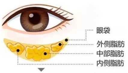 去眼袋手术